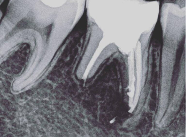 Endodoncia - Regeneracion osea 1 - 1024x754