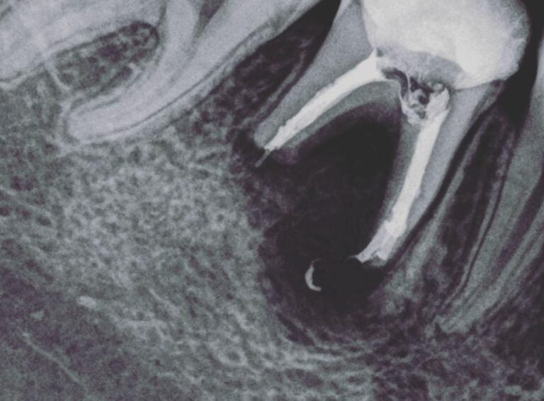 Endodoncia - Regeneracion osea 2