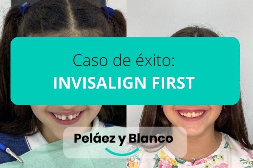 Caso-de-exito-INVISALIGN-FIRST