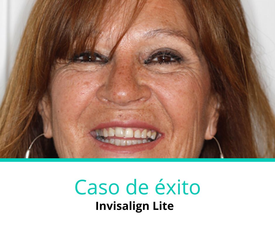 Caso de éxito invisalign lite