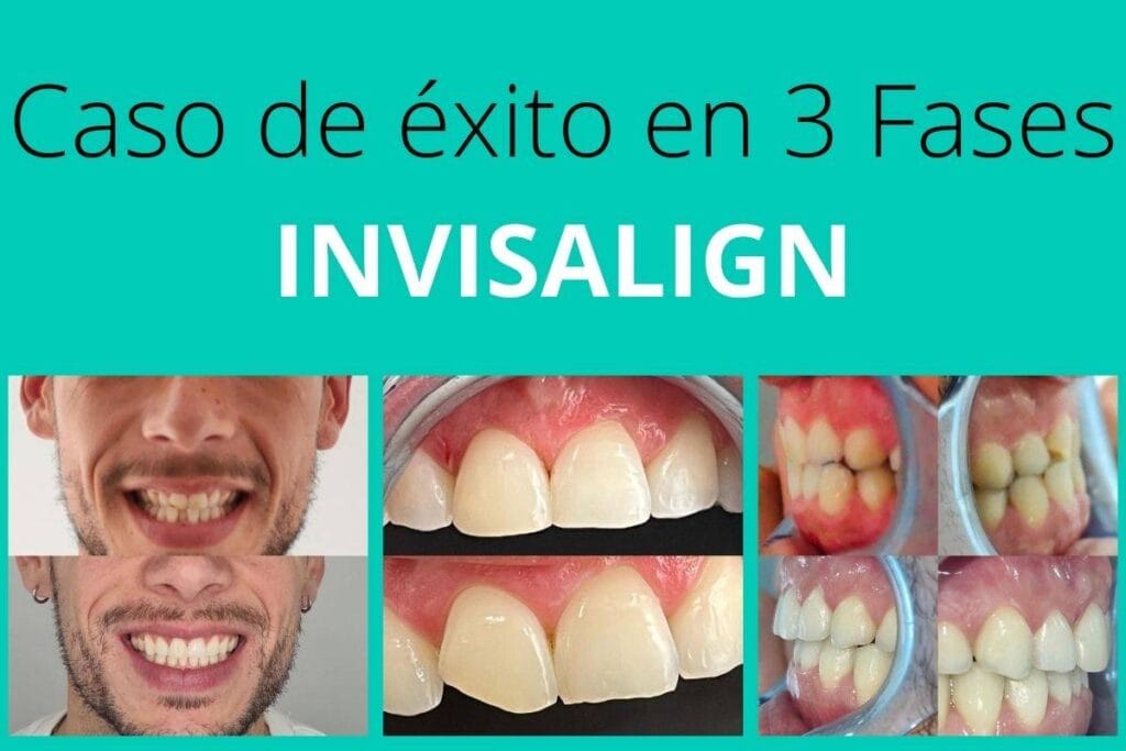 Caso-de-exito-en-3-fases-invisalign-