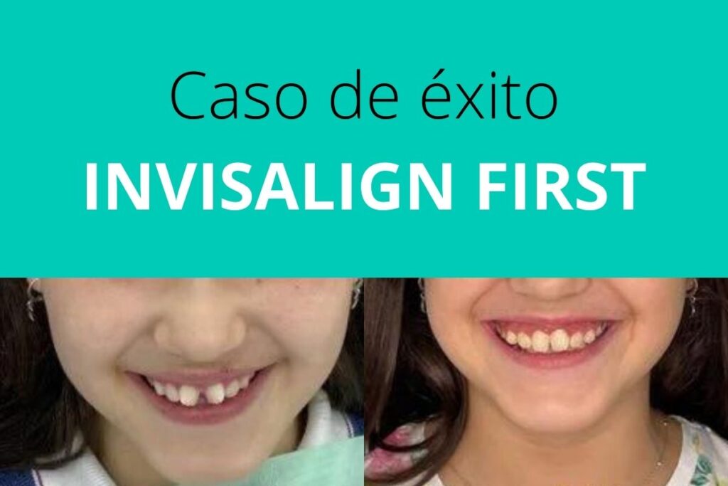 Caso invisalign first