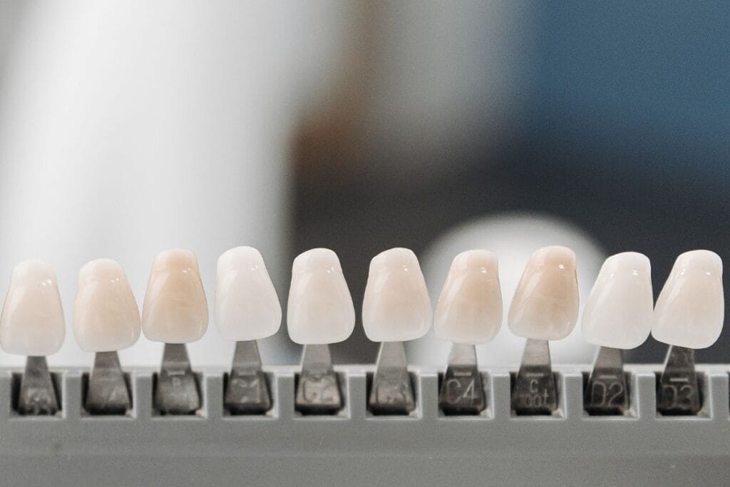 Cuánto duran las carillas dentales